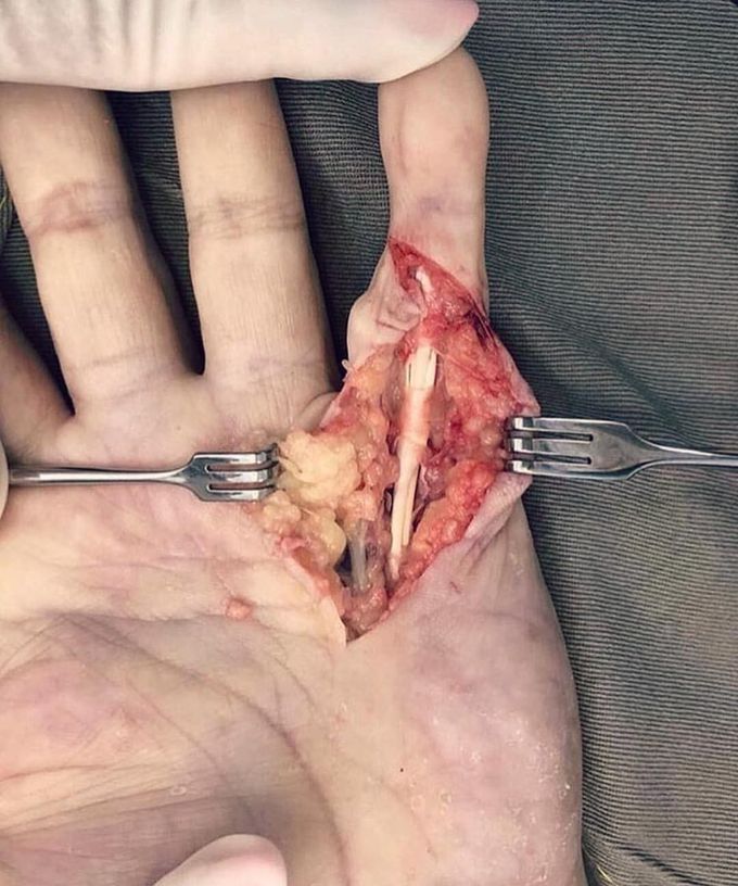Hand tendons