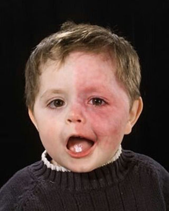 Sturge Weber Syndrome