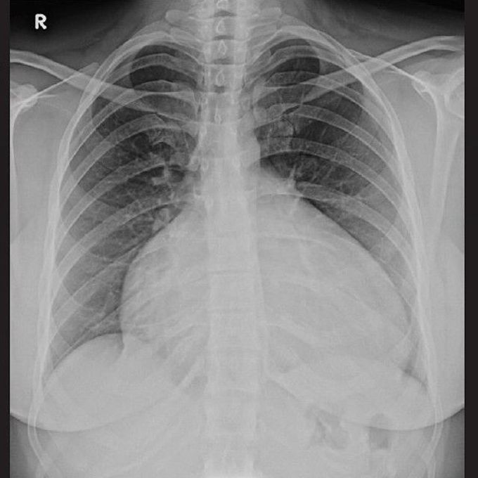 Cardiomegaly