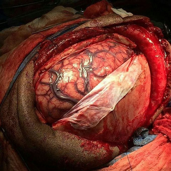Drainage of subdural empyema!