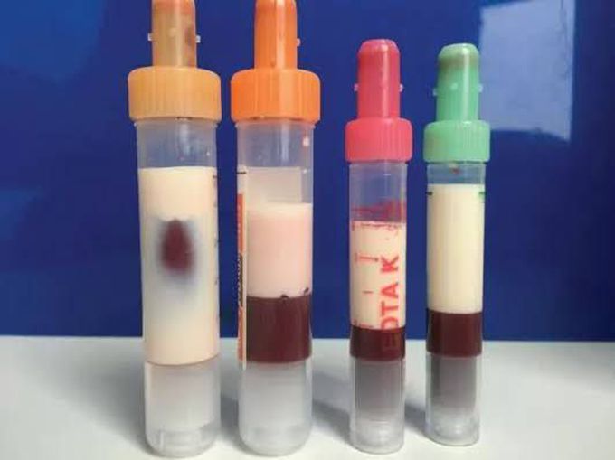 Hypertriglyceridemia