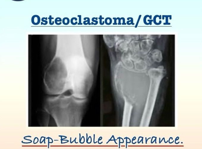 Osteoclastoma