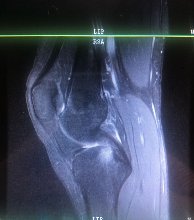 MRI Left Knee