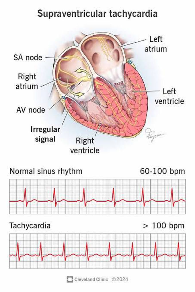 Supraventricular Tachycardia