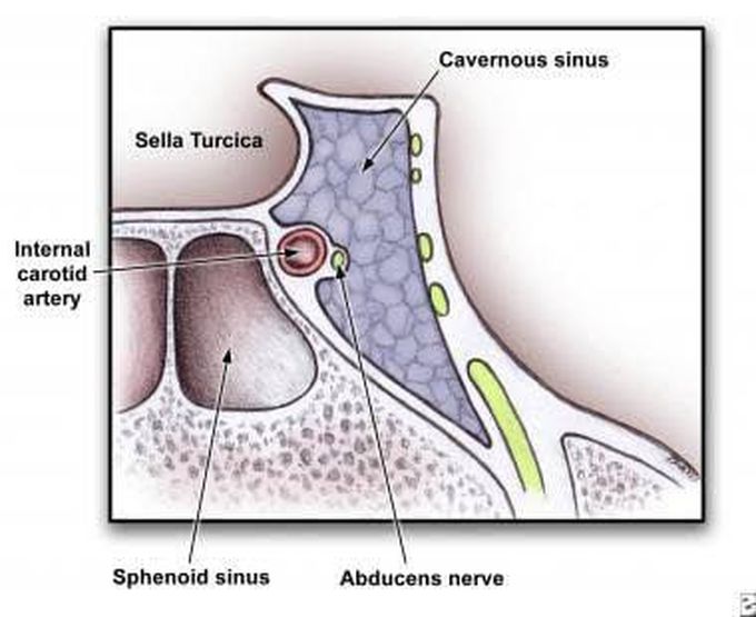 Symptoms of cavernous sinus thrombosis