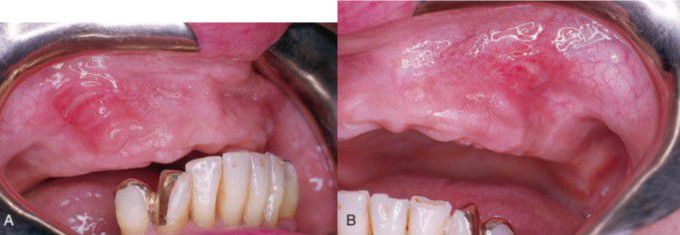 Ulcers due to denture flange