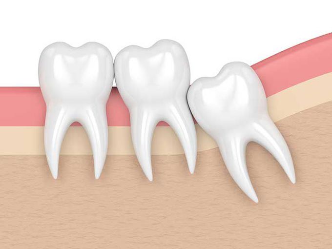 Impacted wisdom teeth