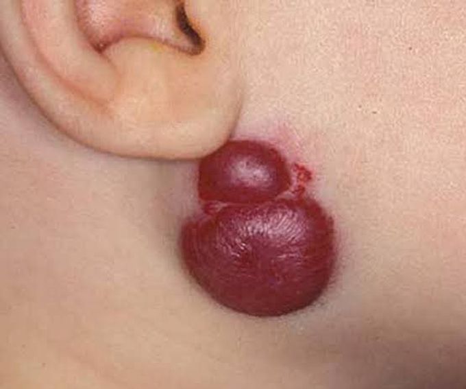 Hemangioma