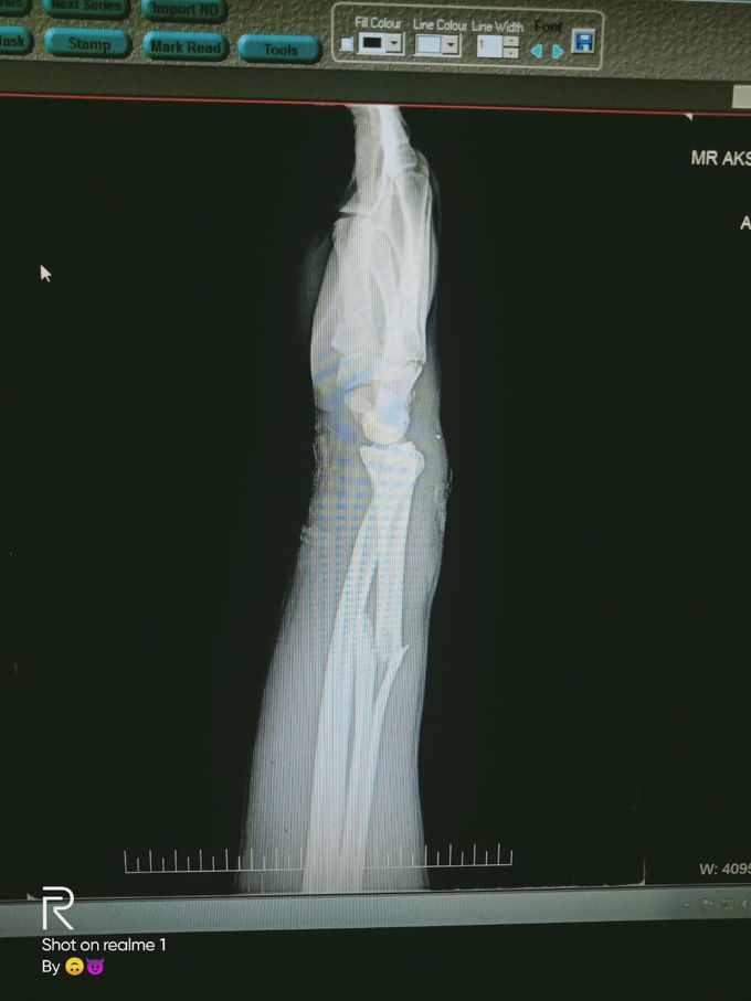 Radial bone