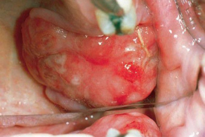 Multiple myeloma involving maxillary tuberosity