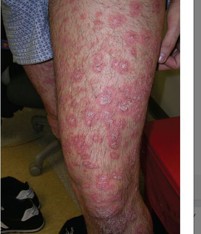 Psoriasis