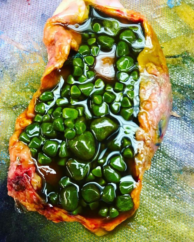 This is a gallbladder full of stones! 