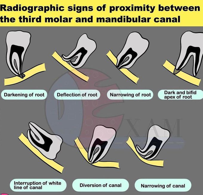 Third Molar and Mandibular Canal Relations