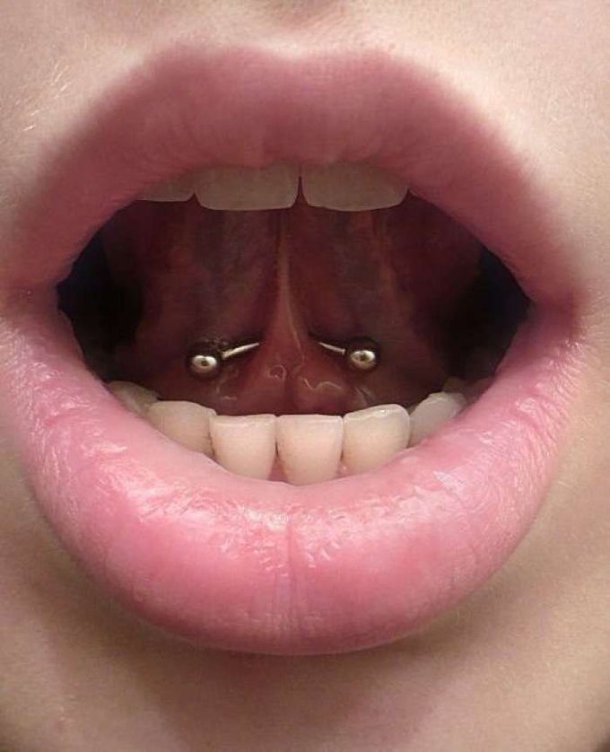 A victim of fashion- Oral piercing leading to infective endocarditis.