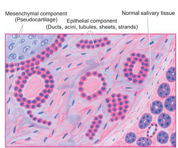 Pleomorphic adenoma.