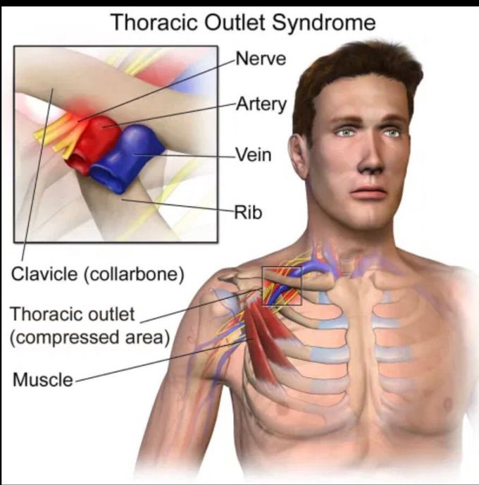 Define Adson’s sign?                                                       In thoracic outlet syndrome, Decrease in ipsilateral radial pulse and or presence of subclavian bruit while patient extend neck maximally, rotating head towards side being tested following deep inspiration/ holding breath.                                                                                           It’s named after Alfred Washington Adson.