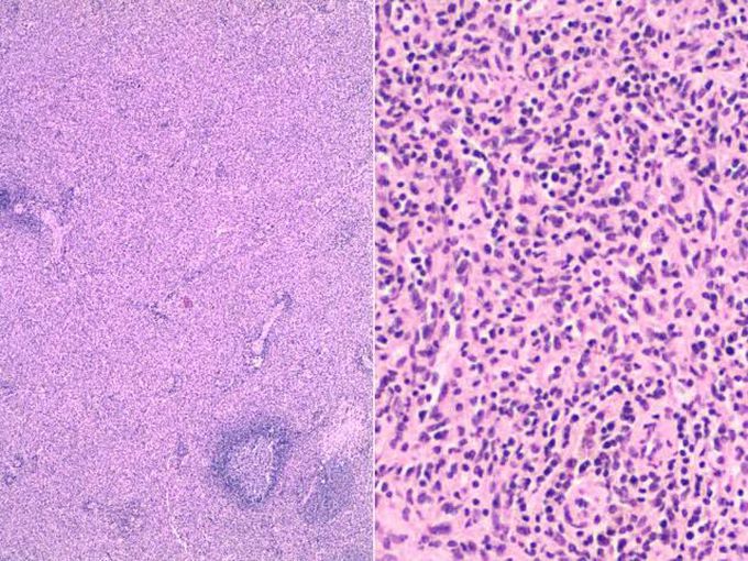 Congestive splenomegaly