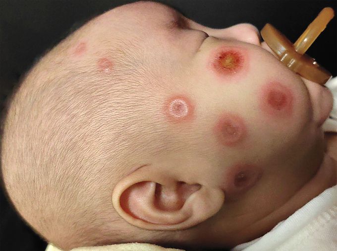 Neonatal Lupus