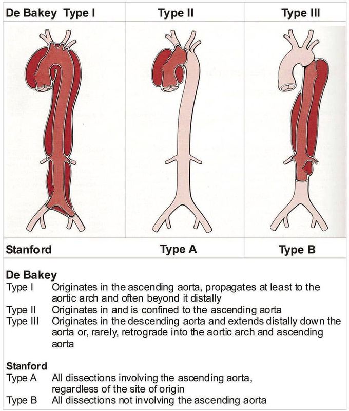 Classification of aortic dissection