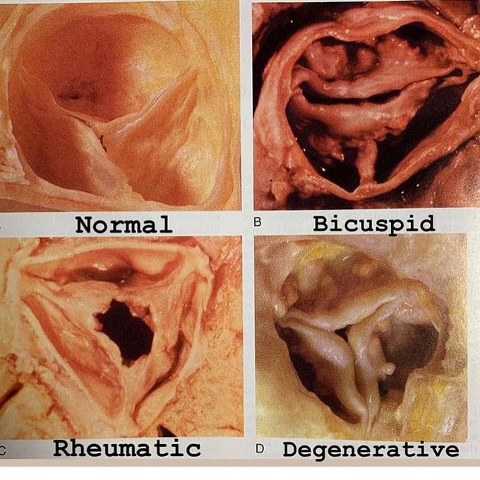 This is an aortic valve with severe aortic stenosis.