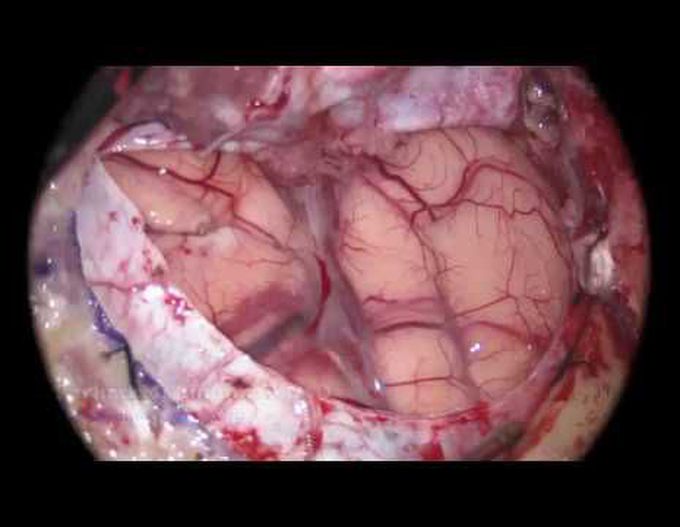 Brain Tumor Surgery: Removal of a large meningioma (sphenoid wing)