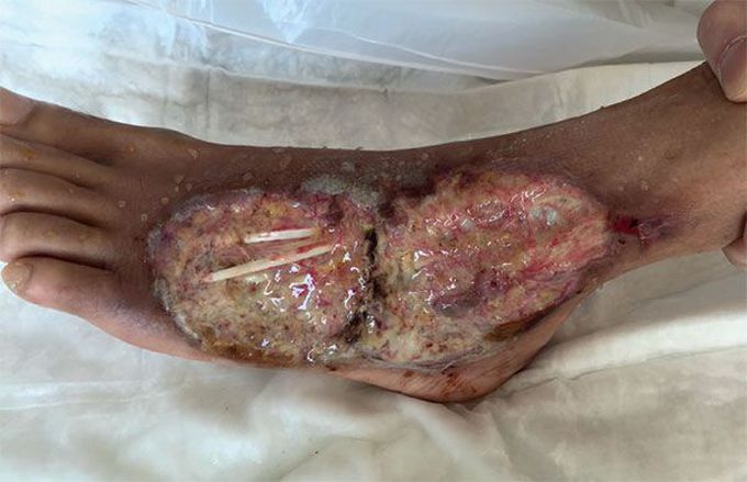 Non-healing foot wound