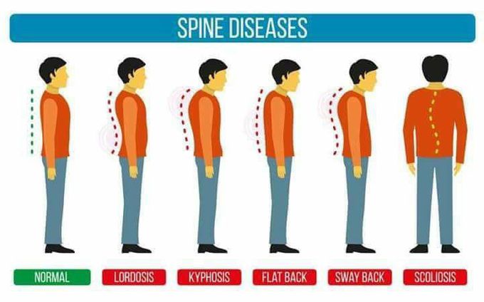 Spine Diseases