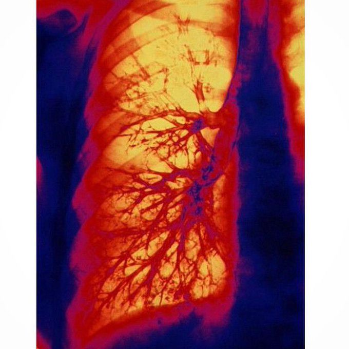 Colored bronchogram (X-ray) of the bronchial tree of a human lung