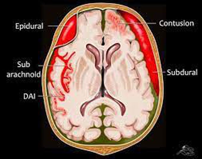 Intracranial hematoma