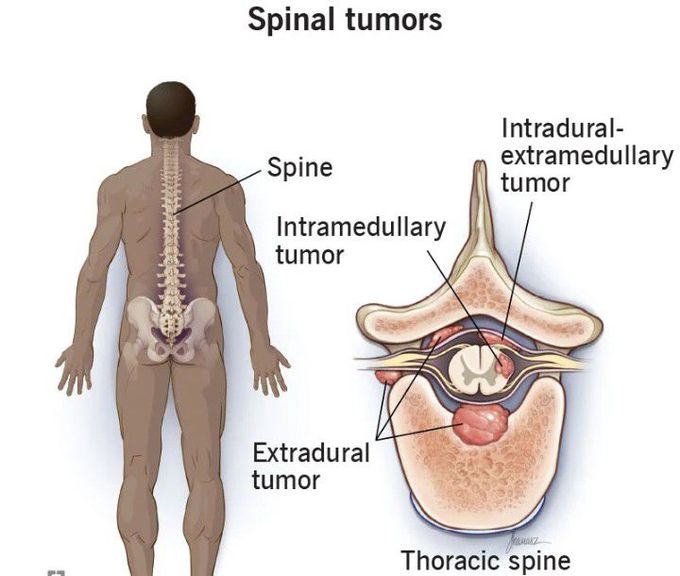 Symptoms of Spinal tumor