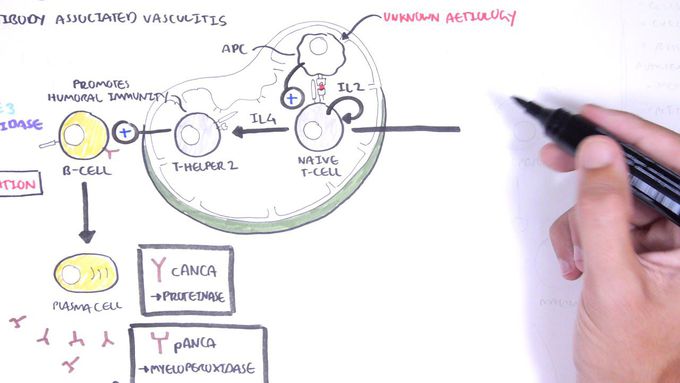 ANCA (Anti-Neutrophil Cytoplasmic Antibody) Associated Vasculitis - Causes, Pathophysiology, Types