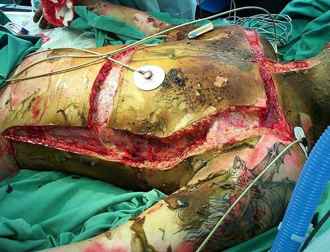 3rd degree burn with escar formation