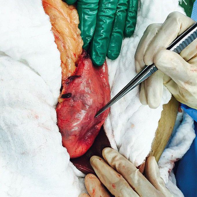 Gastrointestinal Stromal Tumor - GIST