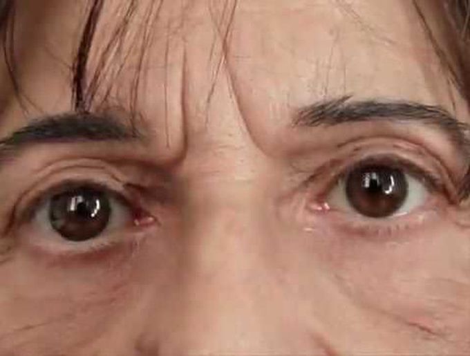 Voluntary Nystagmus