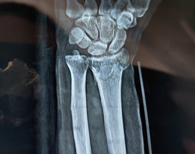 Proximal Radius Fracture