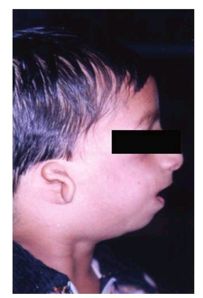 Treacher collin’ s syndrome