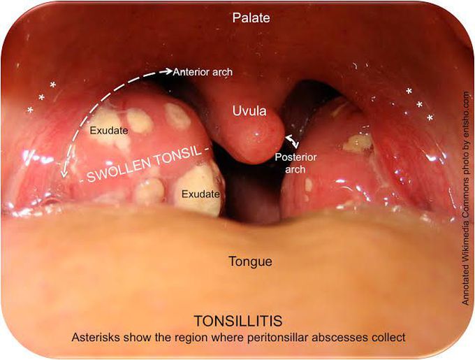 Tonsillitis