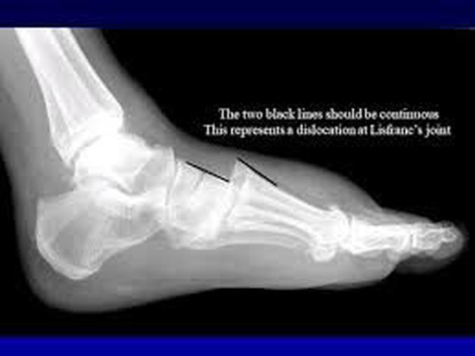 Lisfranc Injury MEDizzy