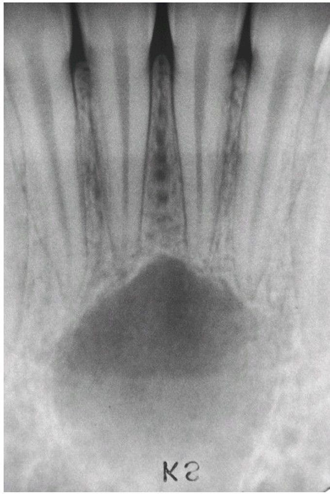 Simple Bone Cyst