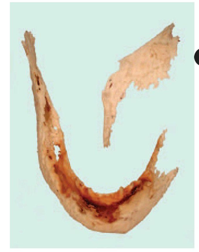 Chronic osteomyelitis