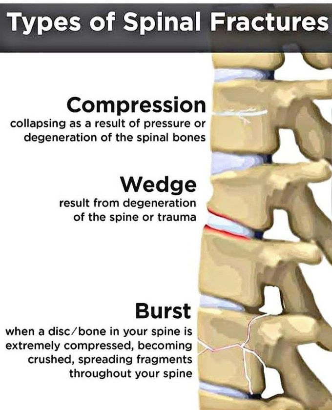 Types of   spinal fracture