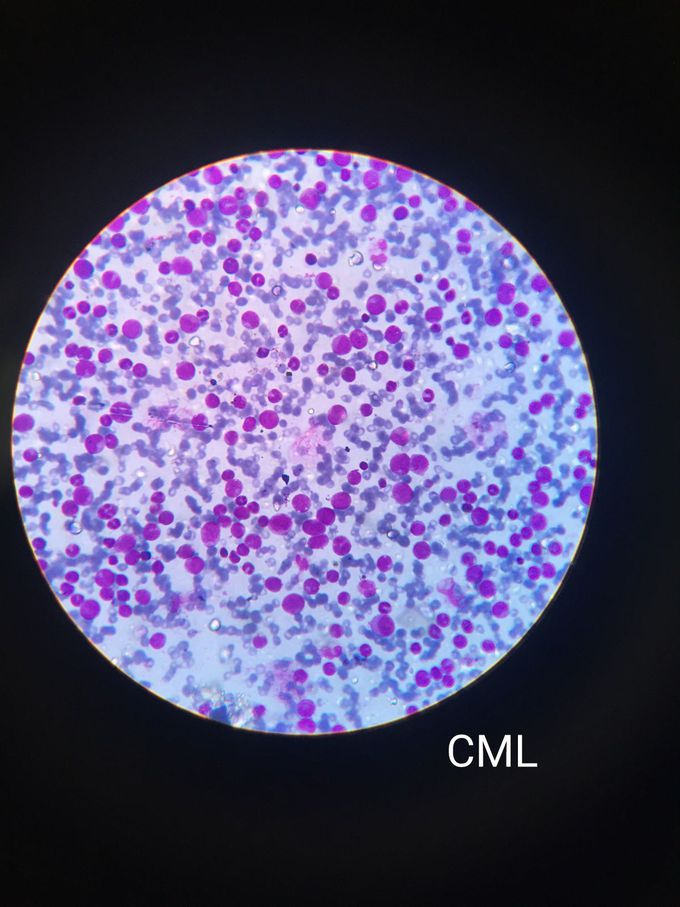 CML - MEDizzy