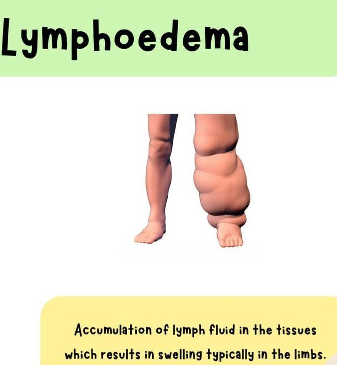 Lymphoedema