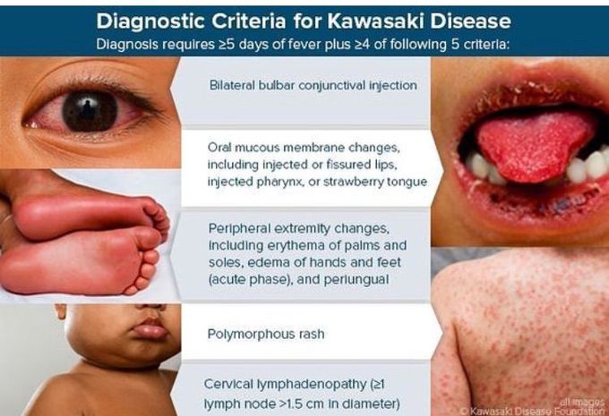 Kawasaki disease