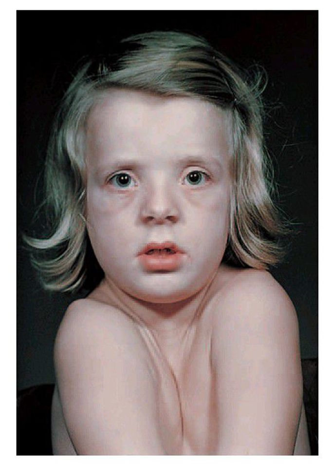 Cleidocranial dysplasia