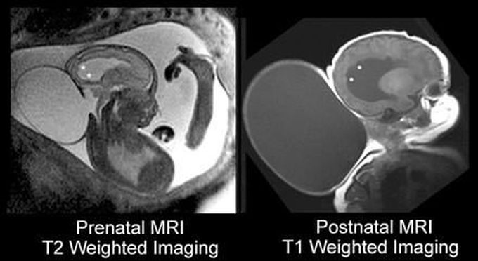 Fetal MRI