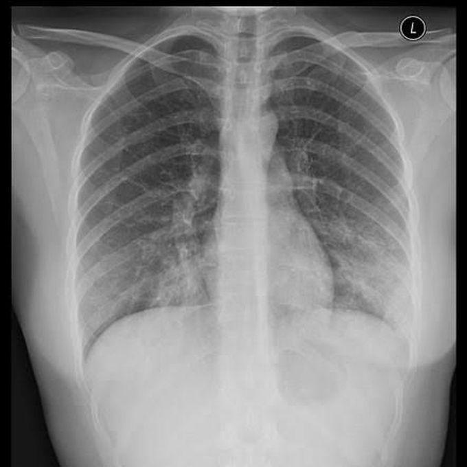 Atypical Pneumonia