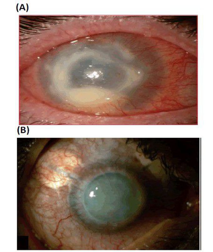 Infected eye