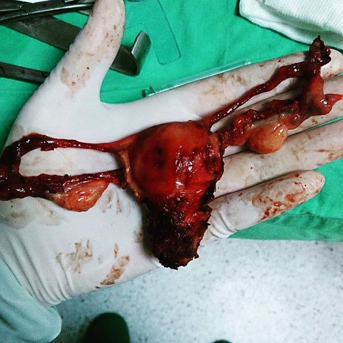 Hysterectomy