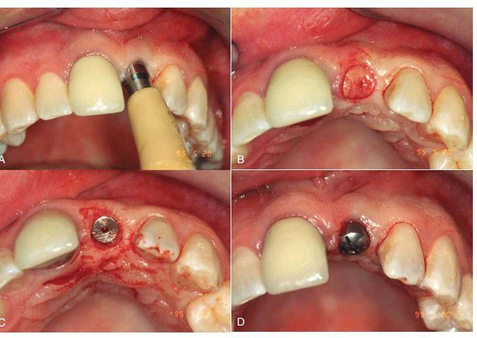 Implant uncovering